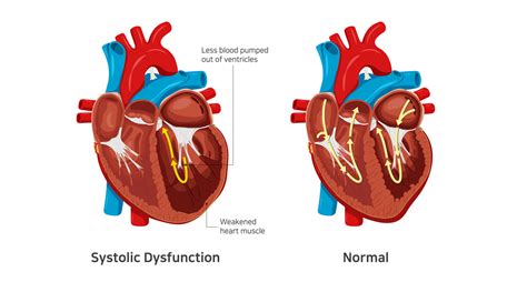 moderate lv systolic dysfunction ef 35|left ventricular systolic heart failure.